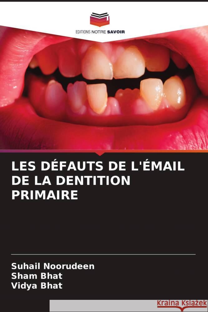 LES DÉFAUTS DE L'ÉMAIL DE LA DENTITION PRIMAIRE Noorudeen, Suhail, Bhat, Sham, Bhat, Vidya 9786204845906