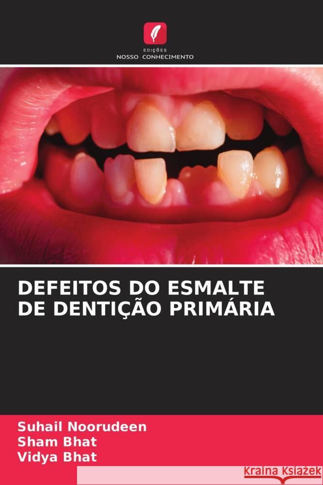 DEFEITOS DO ESMALTE DE DENTIÇÃO PRIMÁRIA Noorudeen, Suhail, Bhat, Sham, Bhat, Vidya 9786204845937