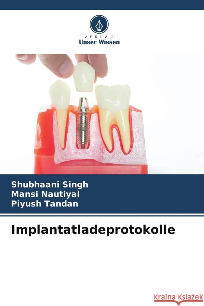 Implantatladeprotokolle Singh, Shubhaani, Nautiyal, Mansi, Tandan, Piyush 9786204857527