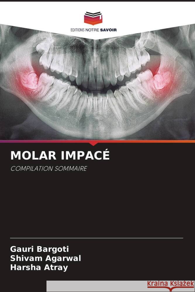 MOLAR IMPACÉ Bargoti, Gauri, Agarwal, Shivam, Atray, Harsha 9786204857718 Editions Notre Savoir