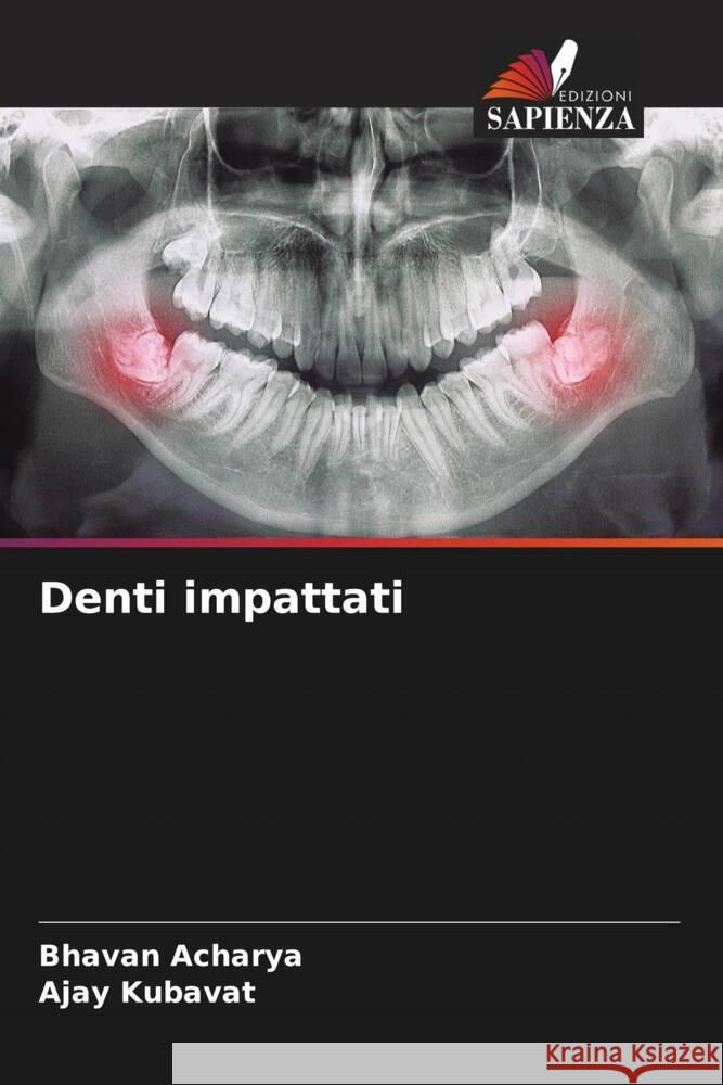 Denti impattati Acharya, Bhavan, KUBAVAT, AJAY 9786204858227 Edizioni Sapienza