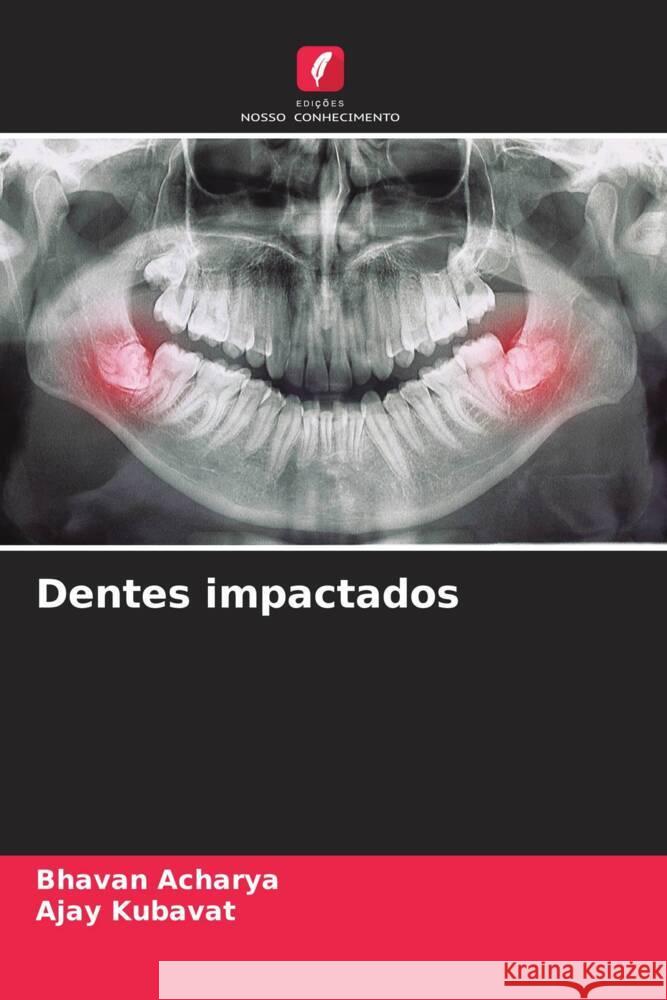 Dentes impactados Acharya, Bhavan, KUBAVAT, AJAY 9786204858234 Edições Nosso Conhecimento