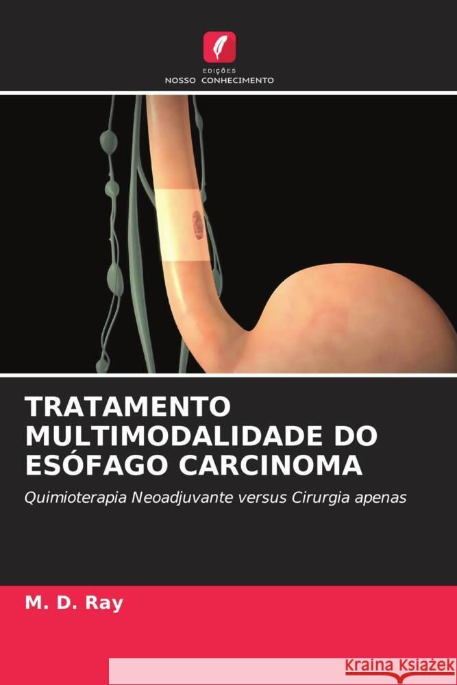 TRATAMENTO MULTIMODALIDADE DO ESÓFAGO CARCINOMA Ray, M. D. 9786204891118 Edições Nosso Conhecimento