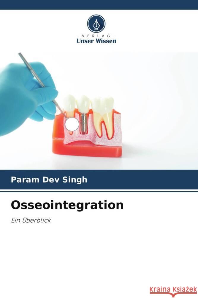 Osseointegration Param Dev Singh Varun Kumar Geeta Arya 9786204929033 Verlag Unser Wissen