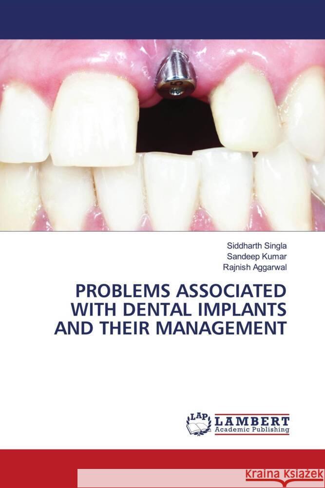 PROBLEMS ASSOCIATED WITH DENTAL IMPLANTS AND THEIR MANAGEMENT Singla, Siddharth, Kumar, Sandeep, AGGARWAL, RAJNISH 9786204984339 LAP Lambert Academic Publishing