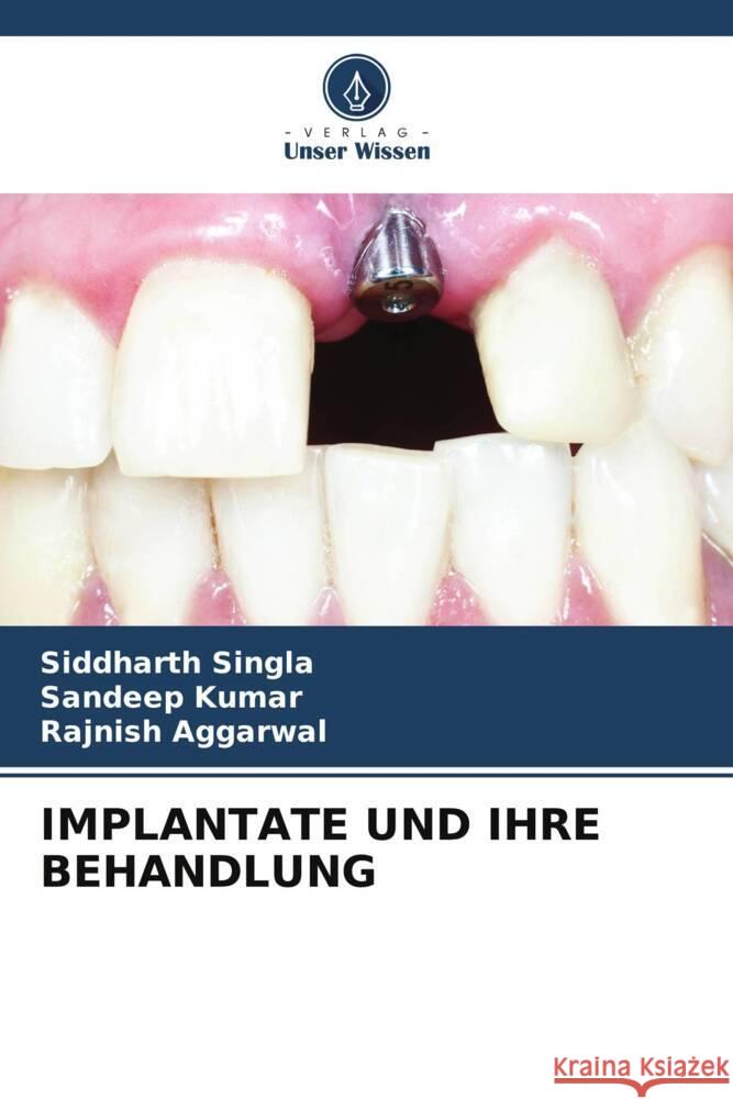 IMPLANTATE UND IHRE BEHANDLUNG Singla, Siddharth, Kumar, Sandeep, AGGARWAL, RAJNISH 9786204993102 Verlag Unser Wissen