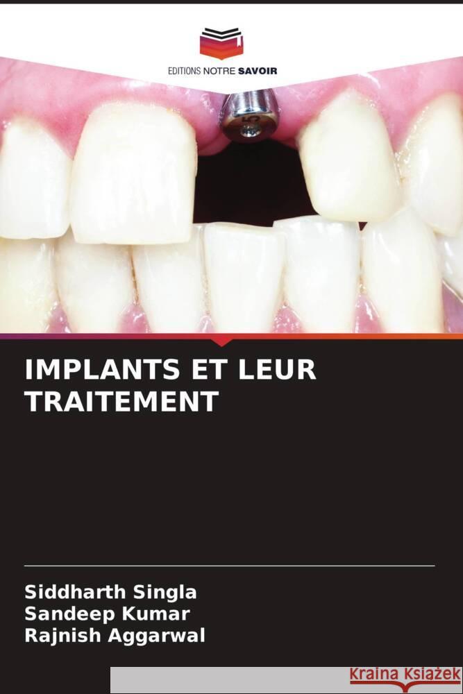 IMPLANTS ET LEUR TRAITEMENT Singla, Siddharth, Kumar, Sandeep, AGGARWAL, RAJNISH 9786204993126 Editions Notre Savoir