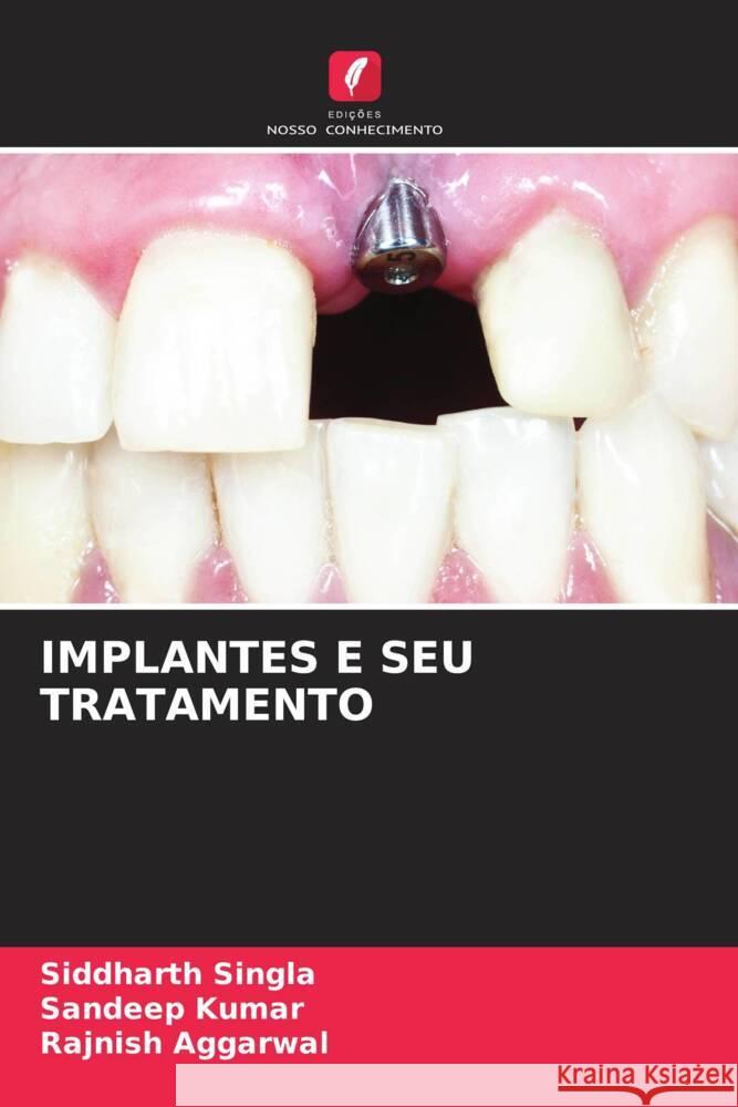 IMPLANTES E SEU TRATAMENTO Singla, Siddharth, Kumar, Sandeep, AGGARWAL, RAJNISH 9786204993140 Edições Nosso Conhecimento