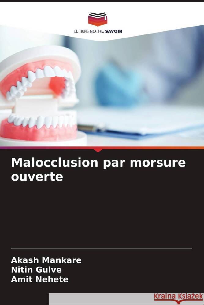 Malocclusion par morsure ouverte Mankare, Akash, Gulve, Nitin, Nehete, Amit 9786205002469 Editions Notre Savoir