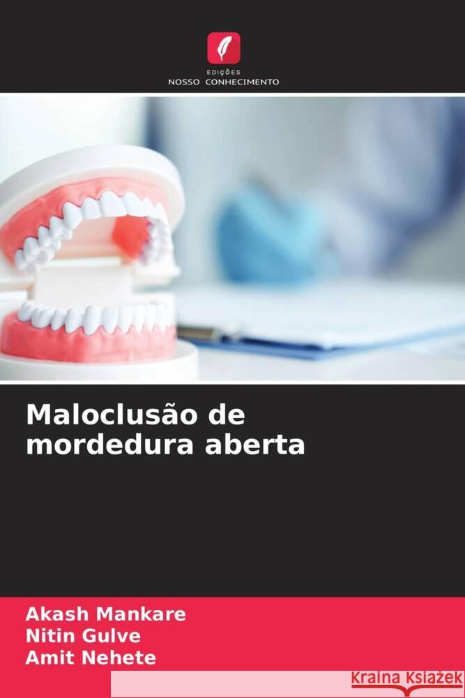 Maloclusão de mordedura aberta Mankare, Akash, Gulve, Nitin, Nehete, Amit 9786205002483 Edições Nosso Conhecimento