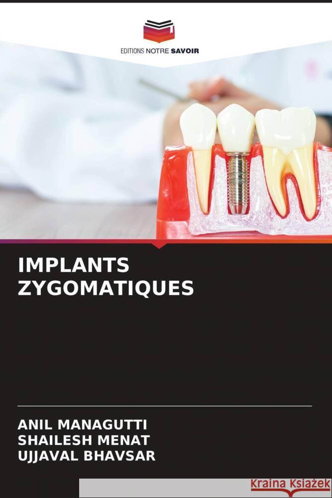 IMPLANTS ZYGOMATIQUES Managutti, Anil, Menat, Shailesh, Bhavsar, Ujjaval 9786205021330