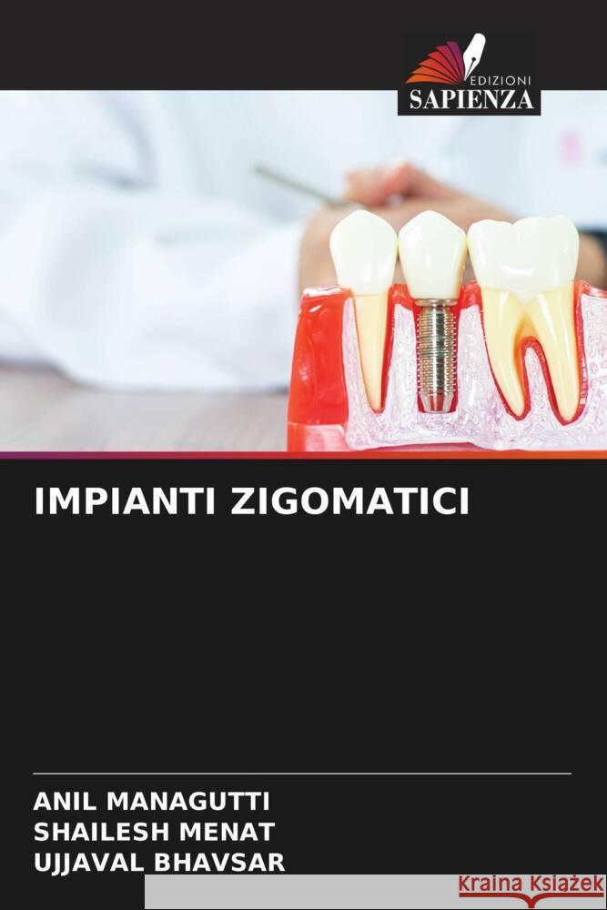 IMPIANTI ZIGOMATICI Managutti, Anil, Menat, Shailesh, Bhavsar, Ujjaval 9786205021354