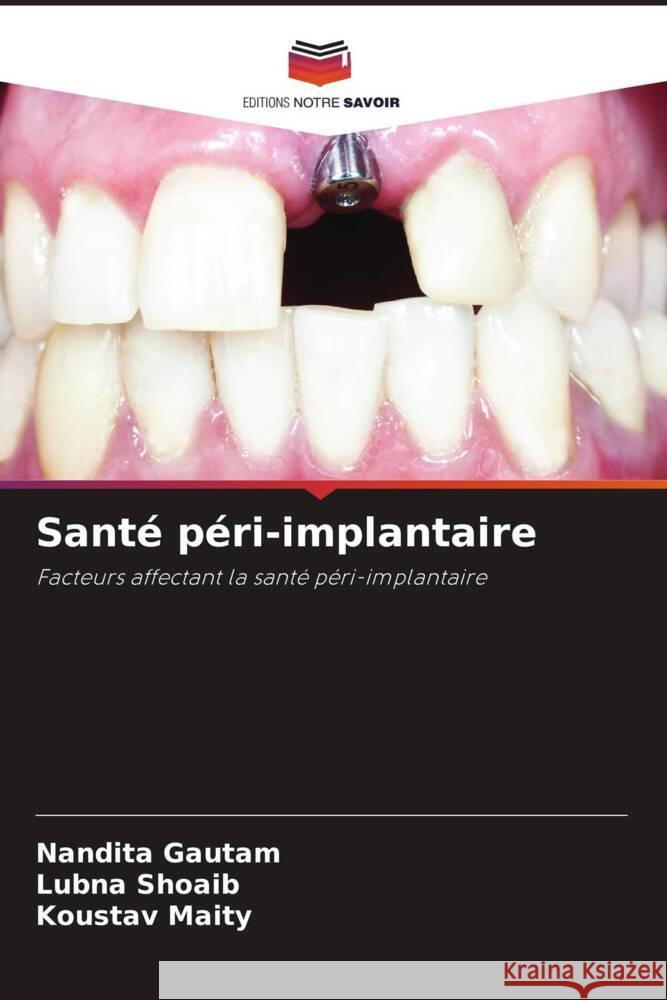 Santé péri-implantaire Gautam, Nandita, Shoaib, Lubna, Maity, Koustav 9786205051566 Editions Notre Savoir