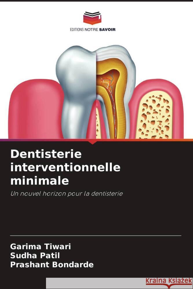 Dentisterie interventionnelle minimale Tiwari, Garima, Patil, Sudha, Bondarde, Prashant 9786205060261 Editions Notre Savoir