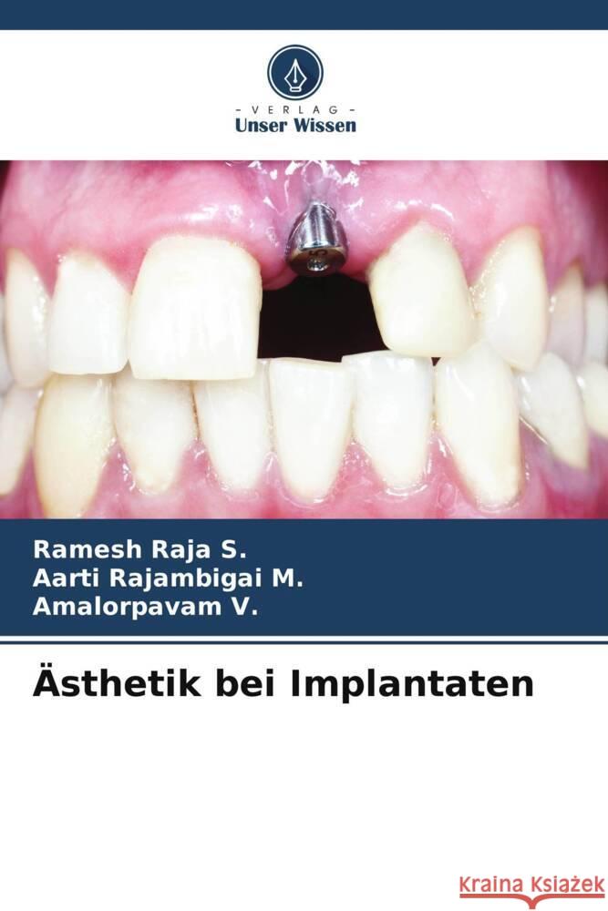 Ästhetik bei Implantaten Raja S., Ramesh, Rajambigai M., Aarti, V., Amalorpavam 9786205073872 Verlag Unser Wissen