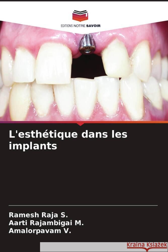 L'esthétique dans les implants Raja S., Ramesh, Rajambigai M., Aarti, V., Amalorpavam 9786205073896 Editions Notre Savoir