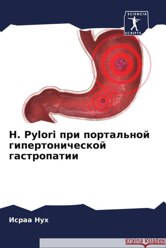 H. Pylori pri portal'noj gipertonicheskoj gastropatii Nuh, Israa 9786205105535