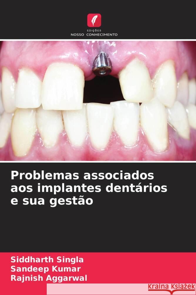 Problemas associados aos implantes dentários e sua gestão Singla, Siddharth, Kumar, Sandeep, AGGARWAL, RAJNISH 9786205108918 Edições Nosso Conhecimento