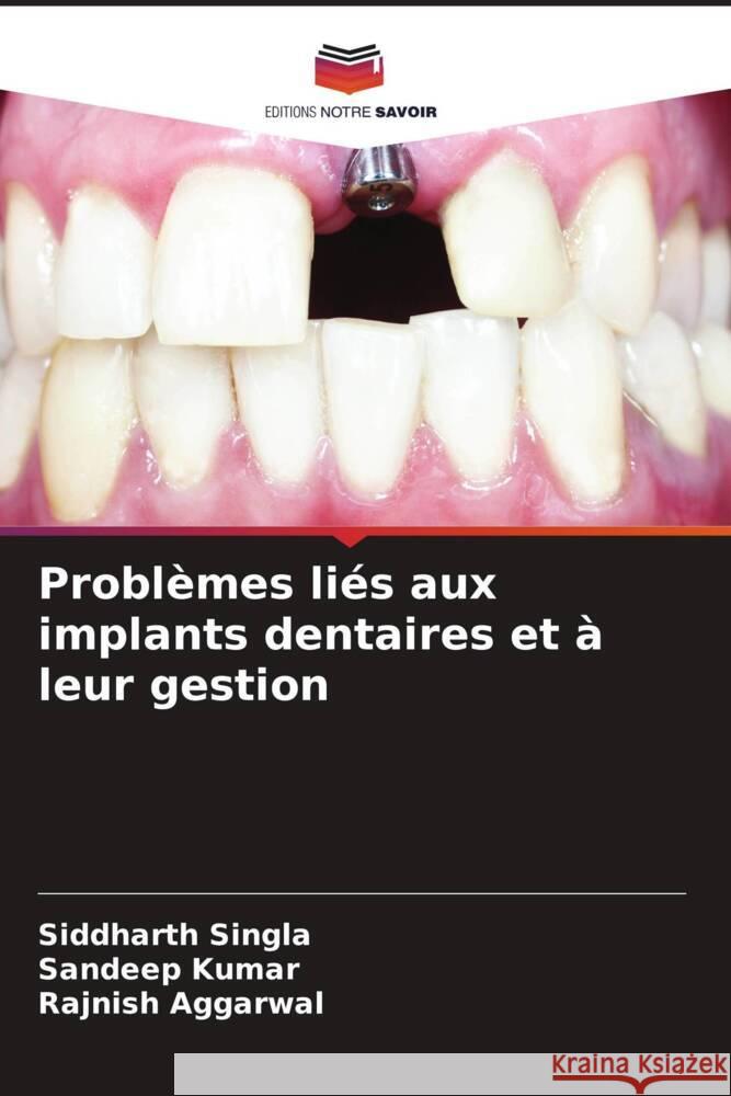 Problèmes liés aux implants dentaires et à leur gestion Singla, Siddharth, Kumar, Sandeep, AGGARWAL, RAJNISH 9786205108949 Editions Notre Savoir