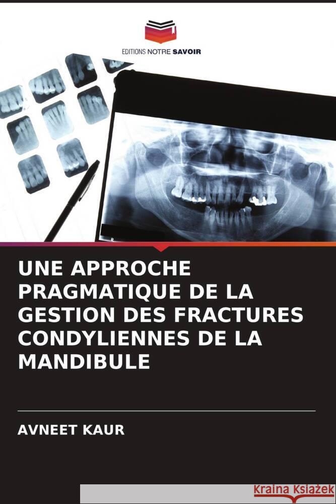 UNE APPROCHE PRAGMATIQUE DE LA GESTION DES FRACTURES CONDYLIENNES DE LA MANDIBULE Kaur, Avneet 9786205138670 Editions Notre Savoir