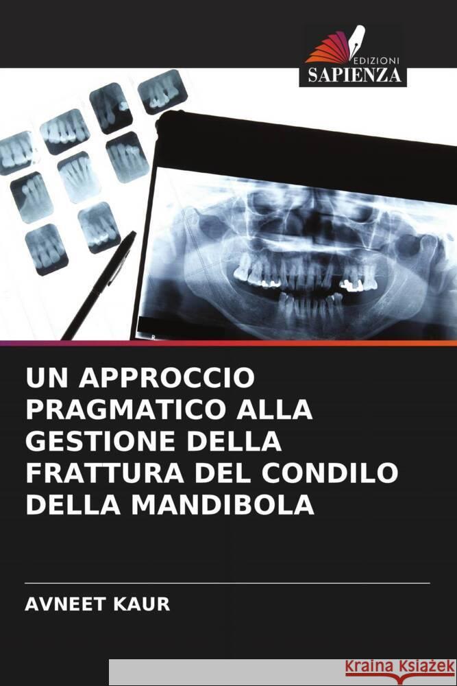 UN APPROCCIO PRAGMATICO ALLA GESTIONE DELLA FRATTURA DEL CONDILO DELLA MANDIBOLA Kaur, Avneet 9786205138687 Edizioni Sapienza