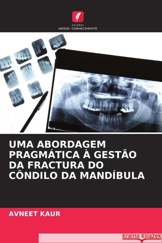 UMA ABORDAGEM PRAGMÁTICA À GESTÃO DA FRACTURA DO CÔNDILO DA MANDÍBULA Kaur, Avneet 9786205138694 Edições Nosso Conhecimento