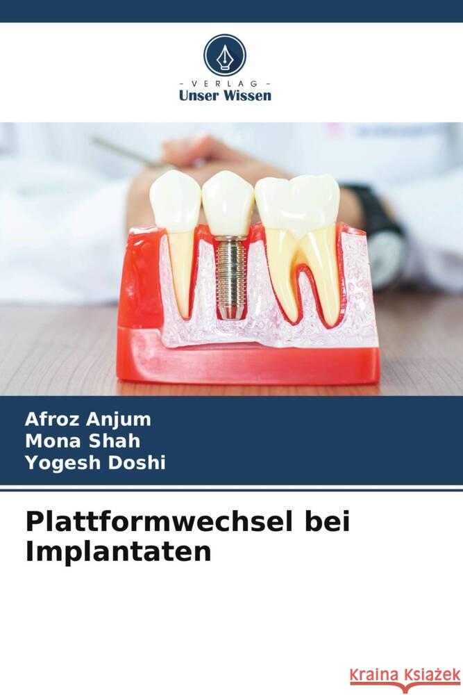 Plattformwechsel bei Implantaten Anjum, Afroz, Shah, Mona, Doshi, Yogesh 9786205164020 Verlag Unser Wissen