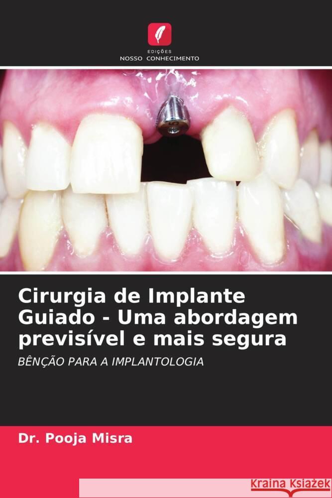 Cirurgia de Implante Guiado - Uma abordagem previsível e mais segura Misra, Dr. Pooja 9786205164792