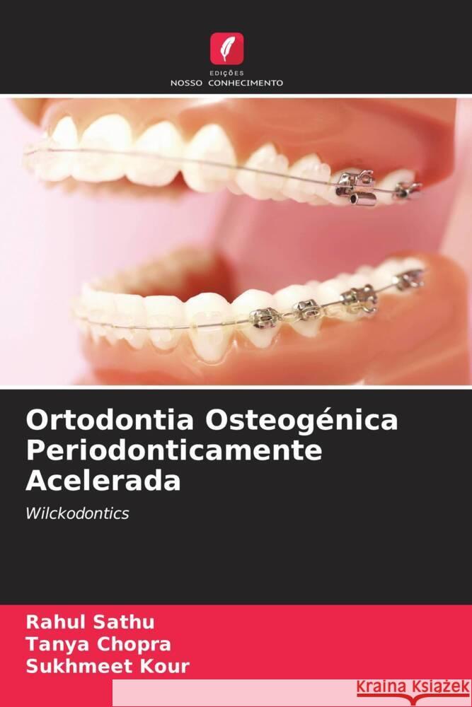 Ortodontia Osteogénica Periodonticamente Acelerada Sathu, Rahul, Chopra, Tanya, Kour, Sukhmeet 9786205245880 Edições Nosso Conhecimento