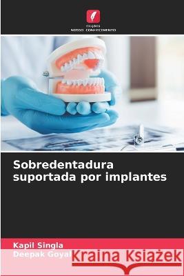 Sobredentadura suportada por implantes Kapil Singla Deepak Goyal  9786205330623 Edicoes Nosso Conhecimento