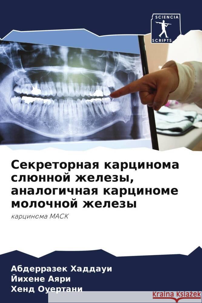 Sekretornaq karcinoma slünnoj zhelezy, analogichnaq karcinome molochnoj zhelezy Haddaui, Abderrazek, Aqri, Jihene, Ouertani, Xend 9786205340714