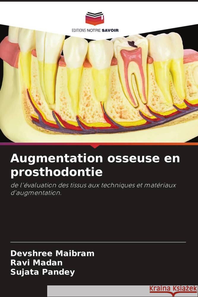 Augmentation osseuse en prosthodontie Maibram, Devshree, Madan, Ravi, Pandey, Sujata 9786205362891 Editions Notre Savoir