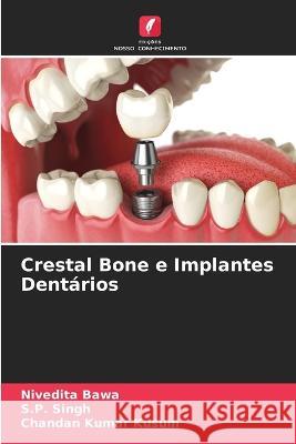 Crestal Bone e Implantes Dentários Nivedita Bawa, S P Singh, Chandan Kumar Kusum 9786205368916 Edicoes Nosso Conhecimento
