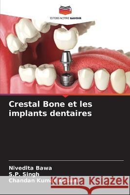 Crestal Bone et les implants dentaires Nivedita Bawa, S P Singh, Chandan Kumar Kusum 9786205368930 Editions Notre Savoir