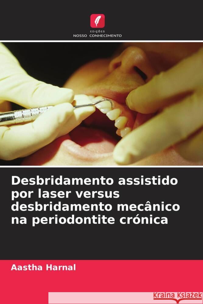 Desbridamento assistido por laser versus desbridamento mecânico na periodontite crónica Aastha Harnal 9786205375693 Edicoes Nosso Conhecimento