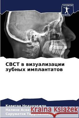 Cbct в визуализации зубных импланта Кавитаа Недунчежян 9786205379424 Sciencia Scripts