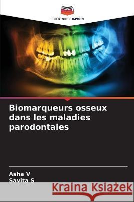 Biomarqueurs osseux dans les maladies parodontales Asha V, Savita S 9786205394908 Editions Notre Savoir