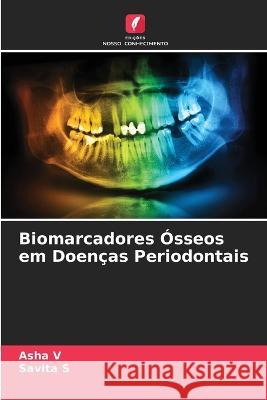 Biomarcadores Ósseos em Doenças Periodontais Asha V, Savita S 9786205394922 Edicoes Nosso Conhecimento