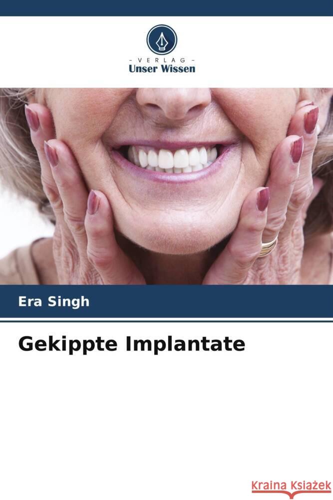 Gekippte Implantate Singh, Era 9786205438596 Verlag Unser Wissen