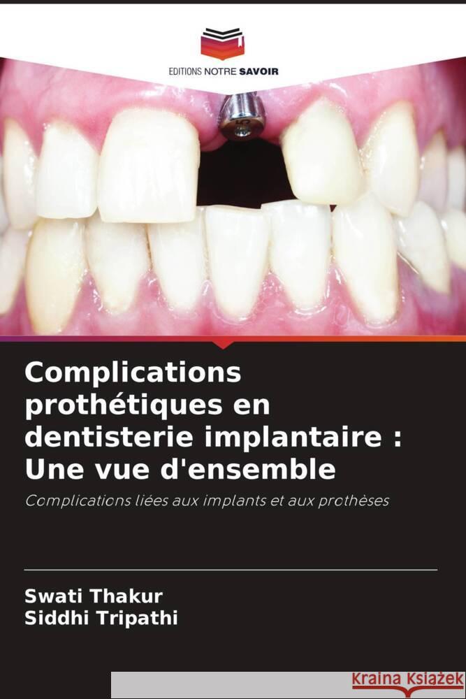 Complications prothétiques en dentisterie implantaire : Une vue d'ensemble Thakur, Swati, Tripathi, Siddhi 9786205452691