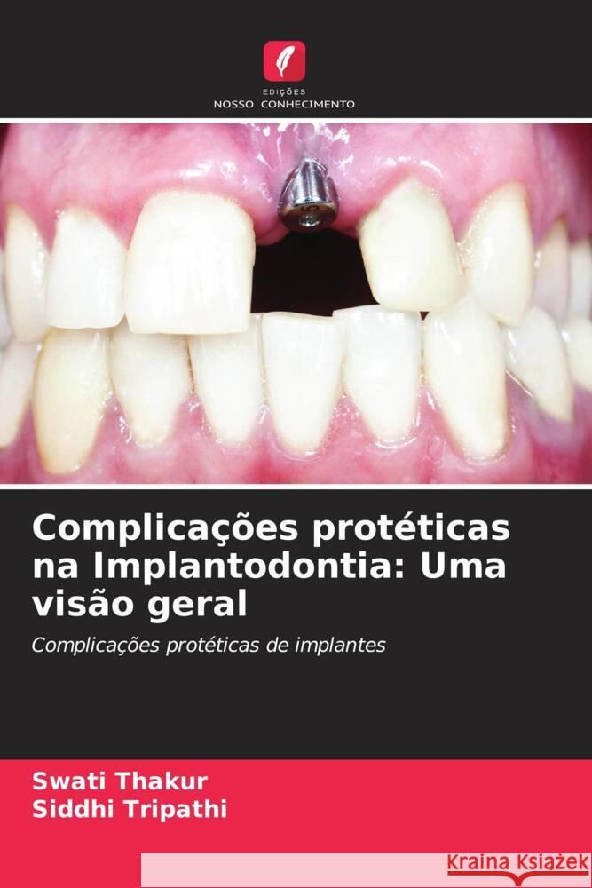 Complicações protéticas na Implantodontia: Uma visão geral Thakur, Swati, Tripathi, Siddhi 9786205452950