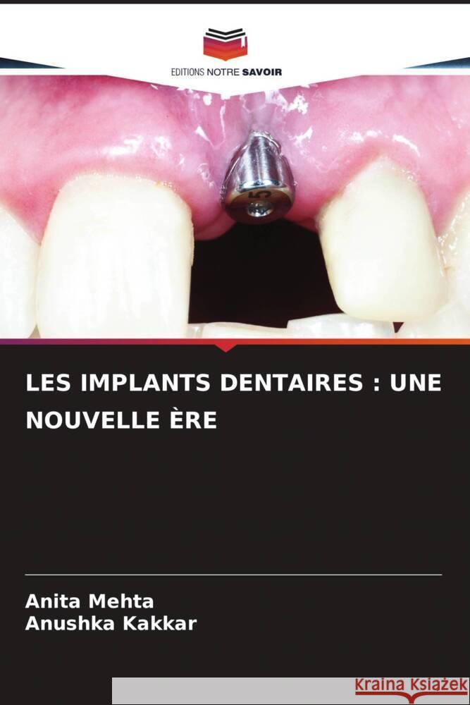 LES IMPLANTS DENTAIRES : UNE NOUVELLE ÈRE Mehta, Anita, Kakkar, Anushka 9786205453117