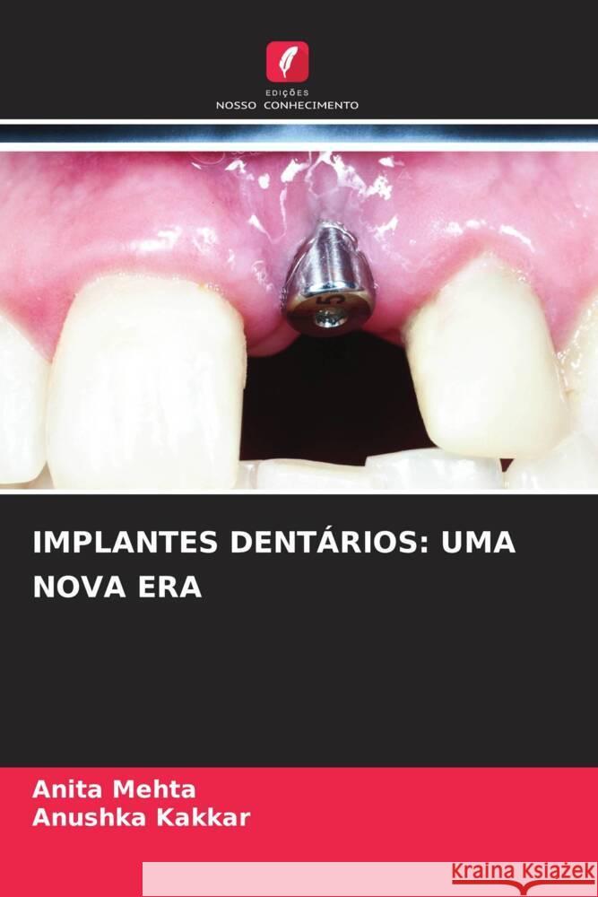 IMPLANTES DENTÁRIOS: UMA NOVA ERA Mehta, Anita, Kakkar, Anushka 9786205453131