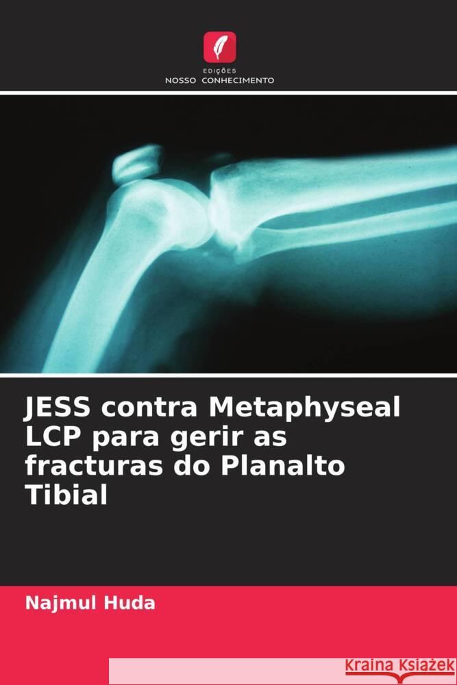 JESS contra Metaphyseal LCP para gerir as fracturas do Planalto Tibial Huda, Najmul 9786205457764 Edições Nosso Conhecimento