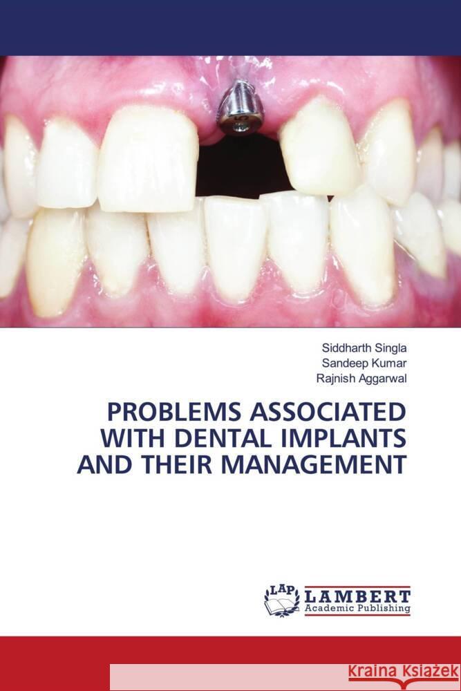 PROBLEMS ASSOCIATED WITH DENTAL IMPLANTS AND THEIR MANAGEMENT Singla, Siddharth, Kumar, Sandeep, AGGARWAL, RAJNISH 9786205488294 LAP Lambert Academic Publishing