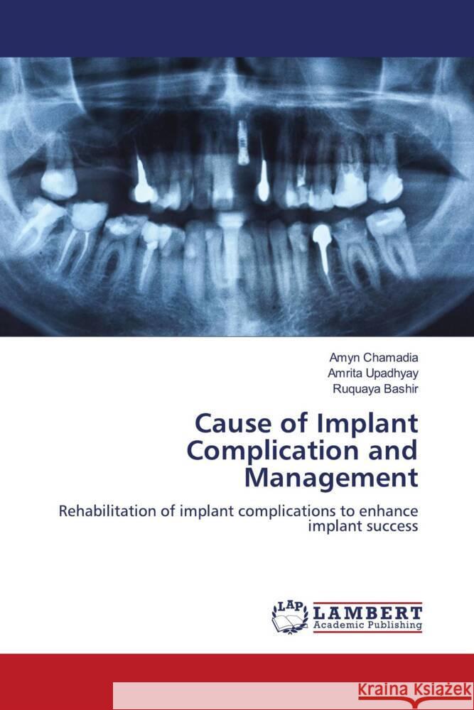 Cause of Implant Complication and Management Chamadia, Amyn, Upadhyay, Amrita, Bashir, Ruquaya 9786205496756