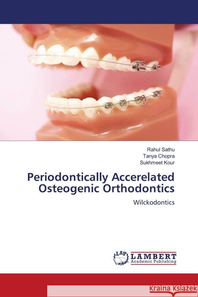 Periodontically Accerelated Osteogenic Orthodontics Sathu, Rahul, Chopra, Tanya, Kour, Sukhmeet 9786205498293 LAP Lambert Academic Publishing