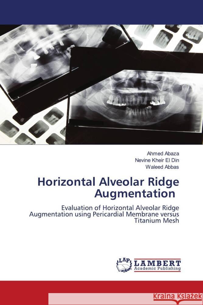 Horizontal Alveolar Ridge Augmentation Abaza, Ahmed, Kheir El Din, Nevine, Abbas, Waleed 9786205511213