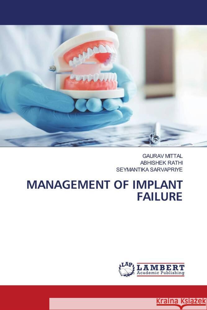 MANAGEMENT OF IMPLANT FAILURE Mittal, Gaurav, Rathi, Abhishek, SARVAPRIYE, SEYMANTIKA 9786205515976