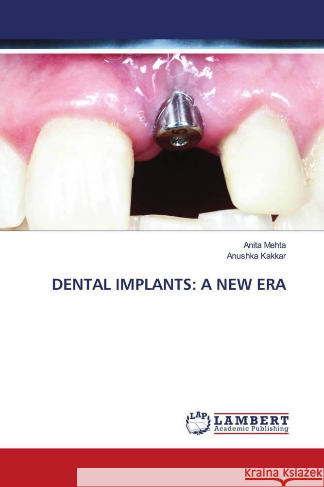 DENTAL IMPLANTS: A NEW ERA Mehta, Anita, Kakkar, Anushka 9786205519141